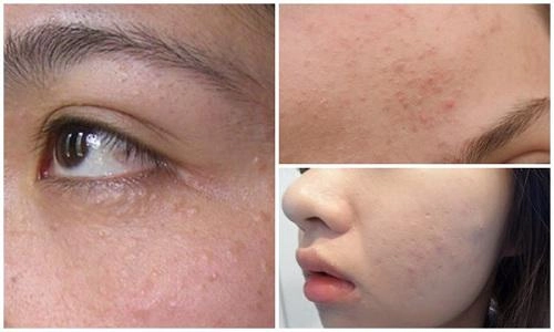 4 cách trị mụn ẩn giúp nhân tự khắc trồi lên mà không cần nặn - 1