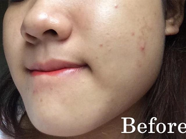 4 cách trị mụn ẩn giúp nhân tự khắc trồi lên mà không cần nặn - 10