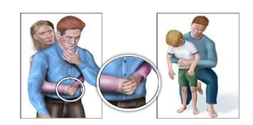 Dùng thủ thuật heimlich khi trẻ bị hóc dị vật - 2