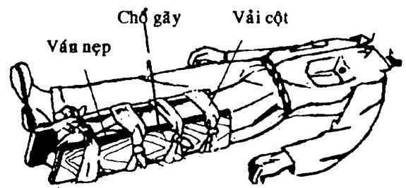 Hướng dẫn sơ cứu các tai nạn trên đường phượt - 5