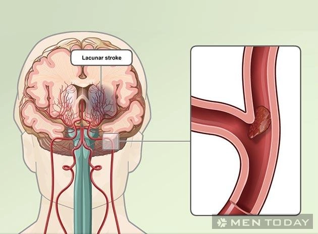 Đột quỵ do rượu bia nhiều - 2