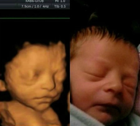 Hình ảnh của bé khi siêu âm và lúc đã chào đời - 7