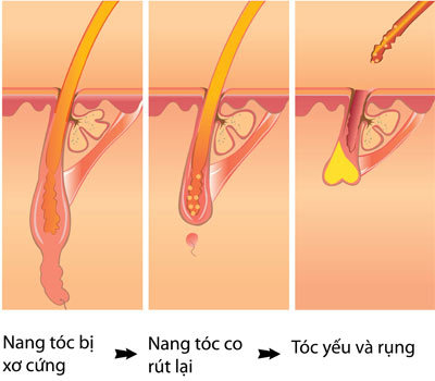 Bệnh rụng tóc và cách điều trị - 1