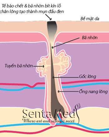 Bị mụn sau khi dùng kem trộn phải làm sao - 1