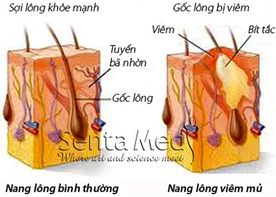 Bị mụn sau khi dùng kem trộn phải làm sao - 2