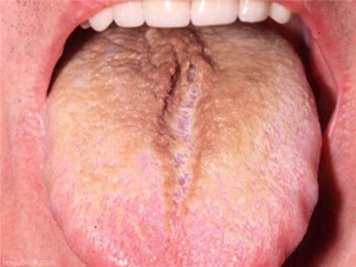 Các dấu hiệu ở lưỡi cảnh báo bệnh nghiêm trọng - 2