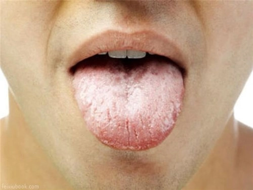 Các dấu hiệu ở lưỡi cảnh báo bệnh nghiêm trọng - 3