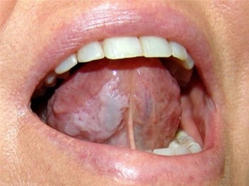 Các dấu hiệu ở lưỡi cảnh báo bệnh nghiêm trọng - 4