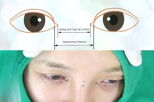 Cận cảnh phương pháp kích mắt to bằng phẫu thuật khóe - 2