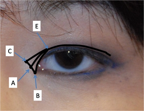 Cận cảnh phương pháp kích mắt to bằng phẫu thuật khóe - 3