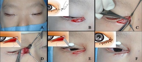 Cận cảnh phương pháp kích mắt to bằng phẫu thuật khóe - 4