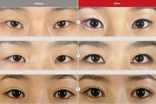 Cận cảnh phương pháp kích mắt to bằng phẫu thuật khóe - 5