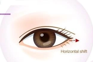 Cận cảnh phương pháp kích mắt to bằng phẫu thuật khóe - 10
