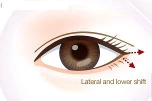 Cận cảnh phương pháp kích mắt to bằng phẫu thuật khóe - 11