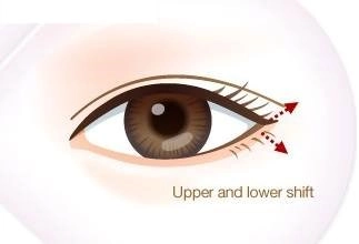 Cận cảnh phương pháp kích mắt to bằng phẫu thuật khóe - 12