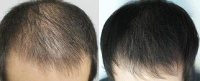 Chữa bệnh rụng tóc bằng công nghệ sinh học prp - 2