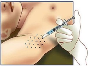 Chữa tăng tiết mồ hôi bằng botox - 2