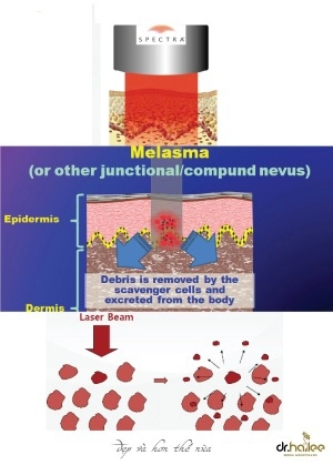 Công nghệ điều trị nám an toàn và hiệu quả - 1