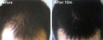 Hết rụng tóc hói đầu sau 3 tháng - 1
