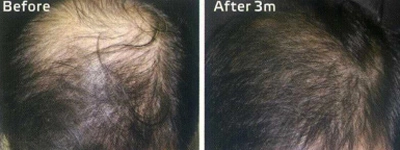 Hết rụng tóc hói đầu sau 3 tháng - 2