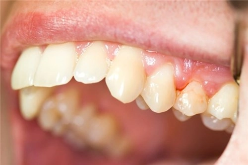 Hiểu 1001 sự thật về răng miệng sẽ giúp bạn tỏa sáng như nữ thần - 7