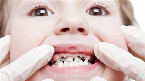 Hiểu 1001 sự thật về răng miệng sẽ giúp bạn tỏa sáng như nữ thần - 13