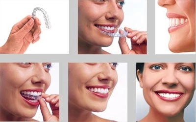 Invisalign - chỉnh nha với loạt khay trong suốt - 1