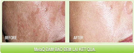 Làn da trắng sáng cùng thảo dược melaq - 3