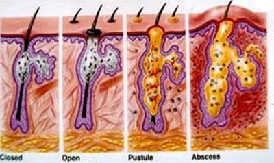 Loại bỏ mụn cấp tốc - 2