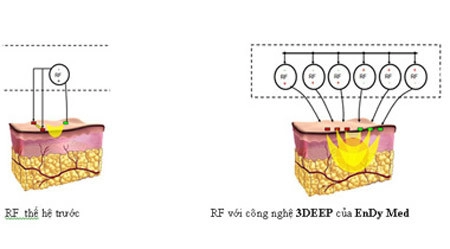 Nâng cơ mặt và làm săn chắc da không đau - 3