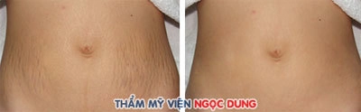 Nguyên nhân và cách điều trị rạn da - 1