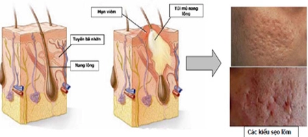 Phòng tránh và điều trị sẹo lõm sau mụn - 1