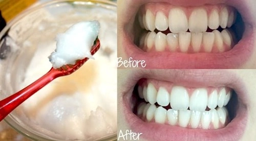 Phương pháp tẩy trắng răng đơn giản và cực hiệu quả sau 7 ngày - 3