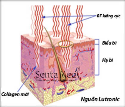 Tại sao gọi là xóa sẹo công nghệ 3d - 1