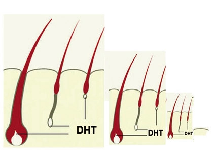 Tái tạo tóc bằng dht và testosteron - 1