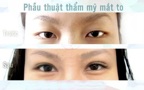 Thẩm mỹ tạo đôi mắt to - 3