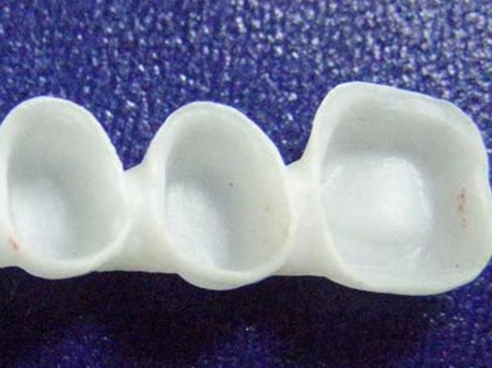 Tính thẩm mỹ của răng sứ toàn sứ cercon - 2