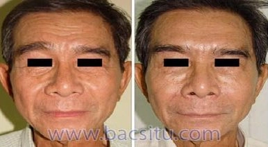 Trẻ lại nhờ botox và restylane - 2