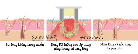 Triệt lông vĩnh viễn có ảnh hưởng đến sinh nở - 2