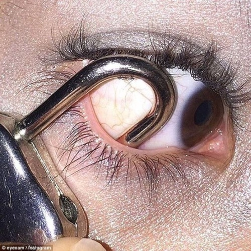 Xăm tròng mắt nhét kim băng móc khóa để làm đẹp cho mắt - 11