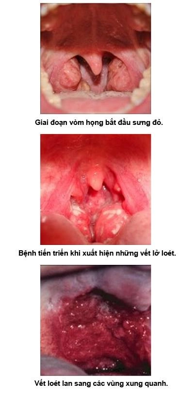 Xem nhanh điều cần biết để phòng tránh bệnh ung thư vòm họng - 1