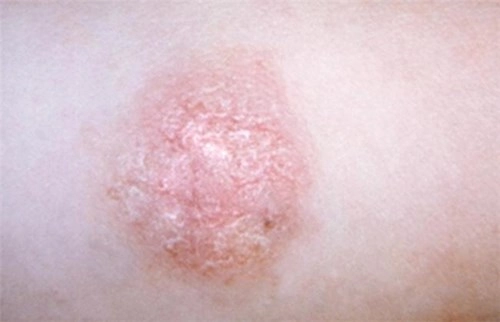 5 bệnh ngoài da thường gặp bị lầm tưởng là bệnh truyền nhiễm - 1