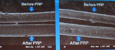 Chữa bệnh rụng tóc bằng công nghệ sinh học prp - 1