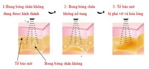 Công nghệ cavi-lipo hút mỡ không phẫu thuật - 2