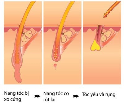 Giải pháp cho hiện tượng rụng tóc - 1