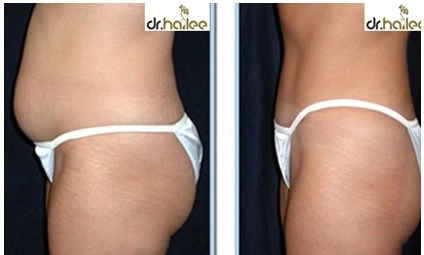 Giảm 8-20cm vòng bụng với cavi-lipo - 4