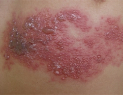 Phân biệt bệnh viêm da do kiến ba khoang và zona - 2