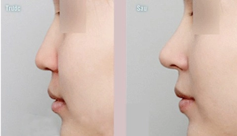 Phẫu thuật mũi ngắn bằng sụn vách ngăn - 2
