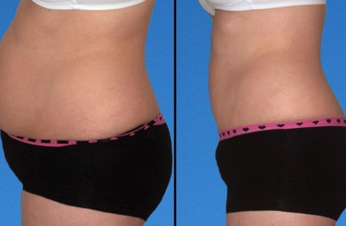 Phương pháp giảm mỡ thừa vùng bụng hiệu quả - 3