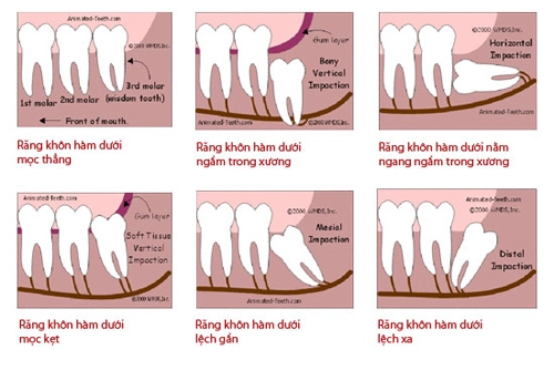 Răng khôn mọc kẹt - 1